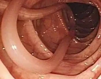 Ascaris lumbricoides